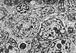 M,55y. | small cell carcinoma - lung